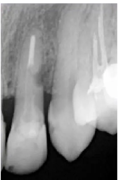 Figura 17 – Raio-x periapical do dente  22. Visível lesão na raiz do dente.