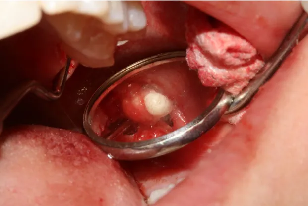 Figura 5- Dente 2.8 