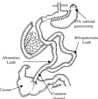 Figure 1 - The biliopancreatic diversion with  duodenal switch operation.