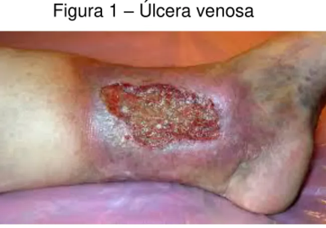 Figura 1  –  Úlcera venosa 