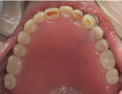 Figura 7 – Exemplo de Prótese parcial removível acrílica superior 