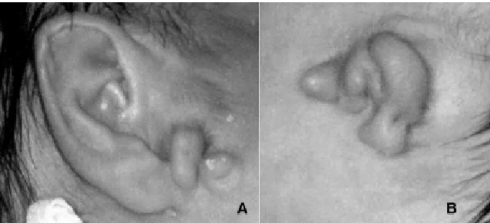 Figura 2  - Displasia de pavilhão auricular com presença de apêndices pré-auriculares (A)