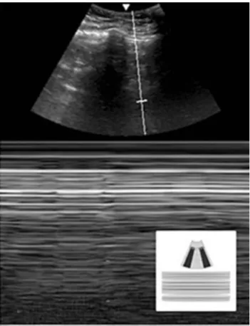 Figure 4 Ultrasound image of abnormal lung presentation with the absence of lung sliding (M-mode): barcode sign.