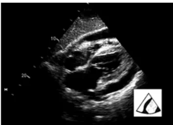 Figure 10 Pericardial effusion with tamponade.