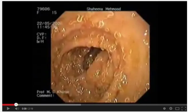 Figura 8 - Vídeo mostra colonoscopia onde toda mucosa intestinal está  revestida com vermes adultos de Trichuris trichiura em 