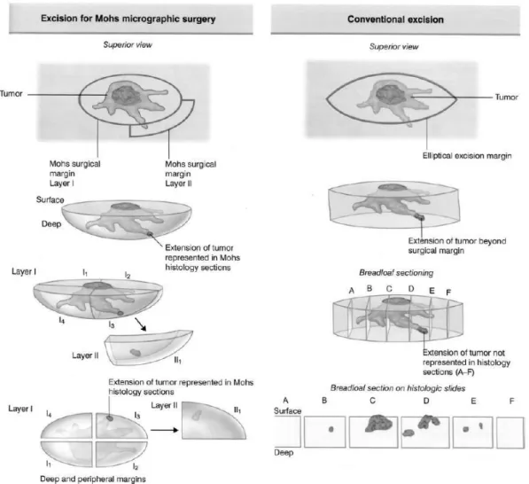 Figura 14. Esquema geral exemplificativo da MMS versus a limitação da excisão de margens convencional