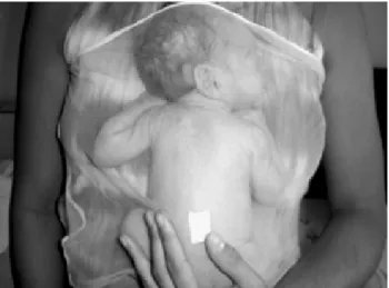 Figura 1 - Bebê em decúbito ventral no canguru, podendo ser verificada sua postura através da faixa confeccionada em tecido tule
