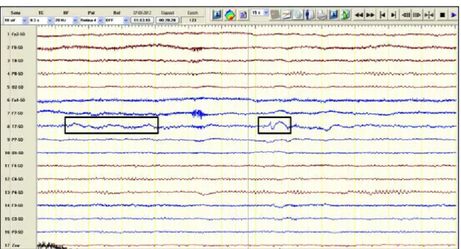 Figure 3.  Focal Slow Wave Activity and Epileptiform activity 