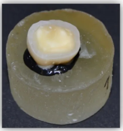 Figure 9: Removing the occlusal enamel                 Figure 10: Mid-coronal dentin                  and superficial dentin