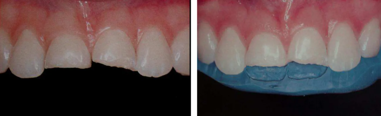 Fig. 1.3: Foto inicial- elementos dentários                        Fig. 1.4: Matriz de silicona    anteriores  fraturados 