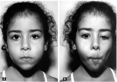 Figura 1 - Criança de 5 anos de idade com fenômeno de Marcus Gunn à direita, ptose palpebral discreta à direita (A), que se transforma em retração palpebral ao movimento mandibular (B)