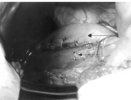 Figura 3 - Fotografia do primeiro plano de sutura da fundoplicatura anterior a Dor sobre área de cardiomiomectomia (seta) parcialmente recoberta pelo fundo gástrico (seta tracejada)