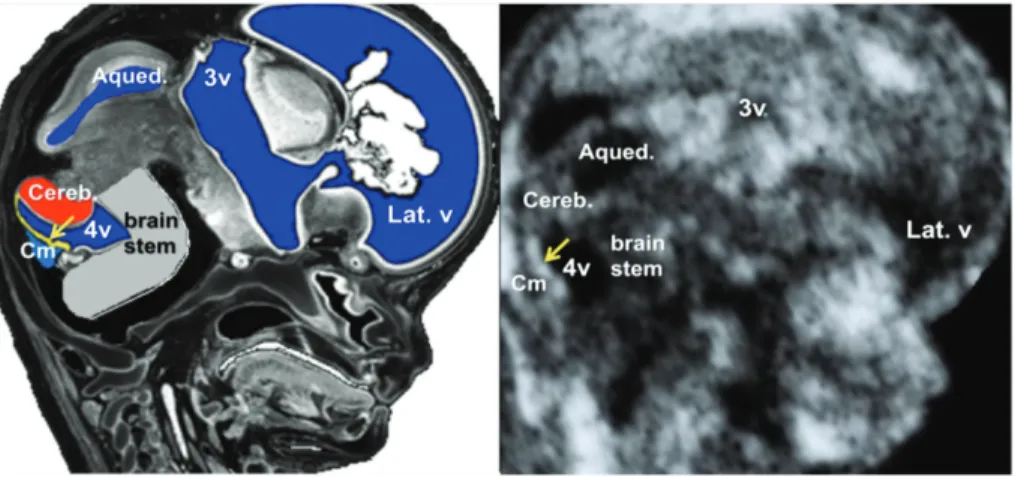 Figure 1: Sonographic image of a para-sagittal plane of the fetal head at 12  weeks’ gestation obtained from a volume acquired by transvaginal (TV)  ultrasound scan (on the right) and corresponding schematic drawing  demonstrating the different components 