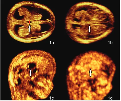 Figure 1 – Lateral third ventricle view in transverse plane (1a and 1b) and  corresponding sagittal plane (1c and 1d) in a normal fetus (left) and one with  open spina bifida (right)