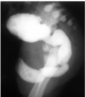 Figura 2 - Uretrocistografia realizada após a ressecção da VUA e fechamento da vesicostomia, mostrando bexiga e uretra com aspectos normais