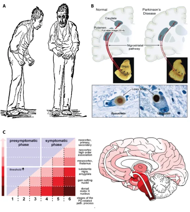 Figure  1.  An  overview  on  PD:  from  patient  to  pathology.  A)  The typical posture of a  PD  patient  was  first  illustrated  by  James  Parkinson  in  his  1918  essay
