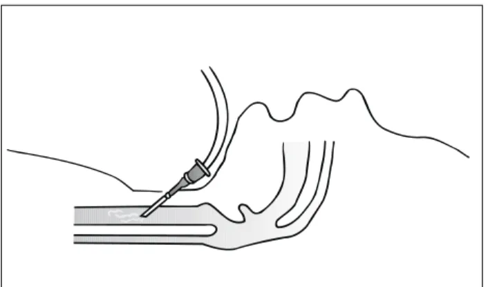 Figura 5 - Ventilação a jato