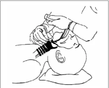 Figura 3 - Intubação orotraqueal com lâmina curva 5
