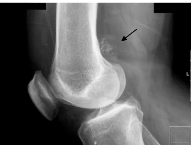 Figura  3.  Radiografia  que  mostra  lesão  suspeita  de  condroma  (periosteal)  de  acordo  com  o  resultado  histopatológico  da  biopsia  percutânea  por  agulha  Trucut  (seta)