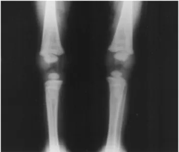 Figura 2 - Radiografia de ossos longos. Linha transversa de densidade radiológica aumentada em região da placa de crescimento