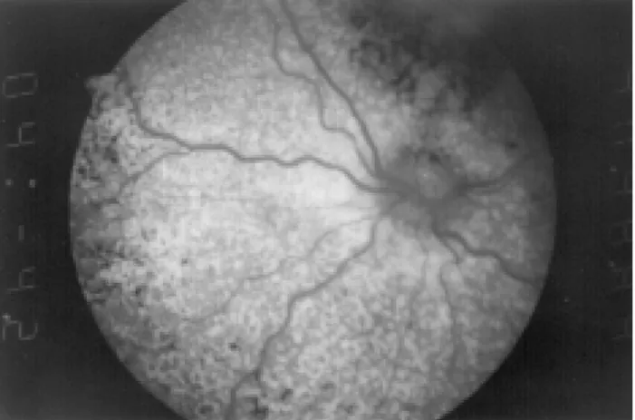 Figura 3 - Fundoscopia indireta. Depósitos difusos de cristais de oxalato na retina