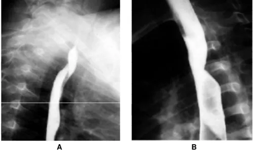 Figura 1 - Esofagograma de artéria subclávia direita anômala.   A - radiografia em oblíquo; B -radiografia em perfil