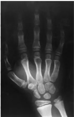Figura 2 - Imagem radiográfica da mão direita do paciente, demonstrando braquidactilia