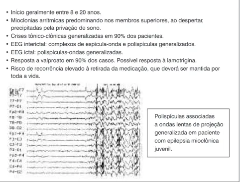 Figura 1 - Epilepsia mioclônica juvenil, uma síndrome idiopática que, quando não