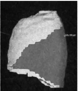 Figura 3  - Volumetria do lobo inferior esquer- esquer-do estabelecida pela CT helicoidalTransplante pulmonar na infância - Camargo JJ et alii