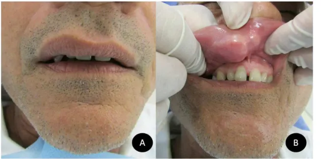 Figura 1. Exame clínico: (A) Discreto aumento de volume na região labial superior; (B) Notável lesão nodular na região de submucosa  labial com superfície de coloração semelhante à da mucosa oral.