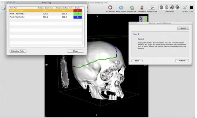Figura 4. Exempliicação do uso da medida de superfície sobre estrutura óssea craniana.