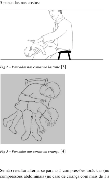 Fig 2 – Pancadas nas costas no lactente  [3] 