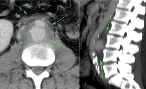 Figura 1. Tomograia computadorizada evidenciando aneurisma de aorta abdominal com sinais sugestivos de infecção.