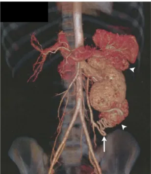 Figura 1. Reconstrução da tomograia computadorizada para  planejamento do tratamento endovascular