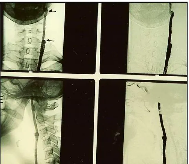 Figura 7. Arteriografia de controle após 60 dias, que não mostrou resquícios tumorais.