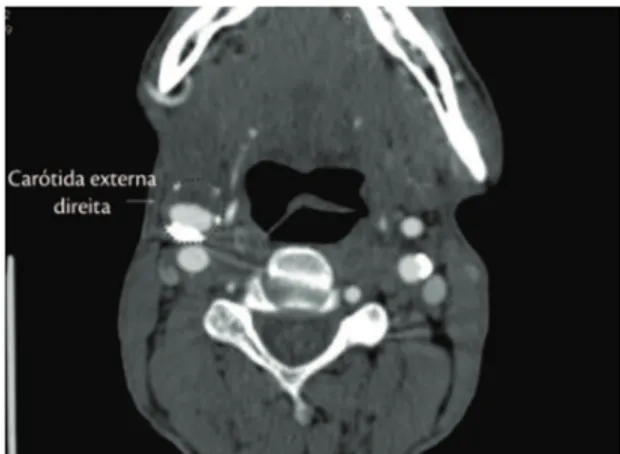 Figura 1. Angiotomograia demonstrando o aneurisma da  artéria carótida externa direita.