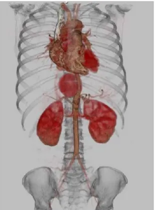 Figura 1. Reconstrução 3D de angiotomograia mostrando  pseudoaneurisma toracoabdominal.