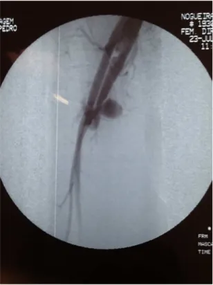 Figura 3. Arteriograia de membro inferior direito com imagem  compatível com pseudoaneurisma e fístula arteriovenosa de  veia femoral comum.
