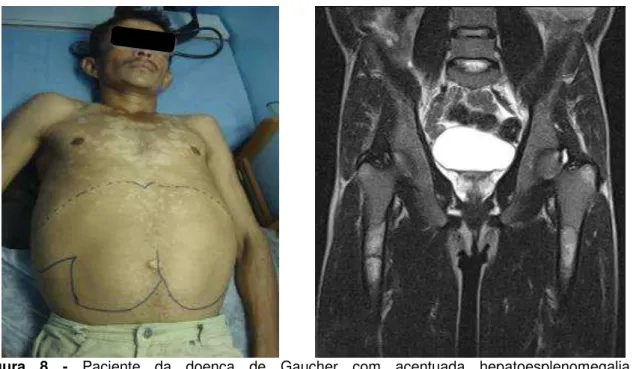 Figura  8  -  Paciente  da  doença  de  Gaucher  com  acentuada  hepatoesplenomegalia  e 