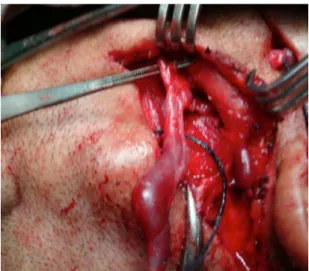 Figura 3. Aspecto intraoperatório.