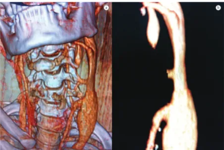 Figura 2. Angiotomograia com reconstrução (A) demonstrando fístula arteriovenosa entre artéria carótida comum esquerda 
