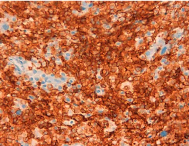 Fig. 4.  Bone biopsy image revealing irregular nuclei and the pres- pres-ence of a nucleolus (orange stain) in T-cell lymphoid cells.