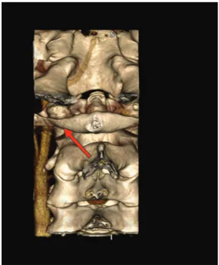 Figura  2. Artéria hipoglossa passando pelo canal do 