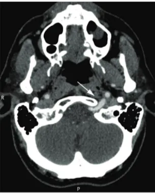 Figura 3. Tomograia em corte transversal mostrando a artéria 