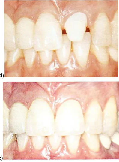 Figura  2:  a)  Remanescente  radicular,  b)  Reconstrução  radicular  com  pino  de  fibra  de  vidro, c) Características finais do preparo, d) Prova da infra-estrutura In Ceram Alumina,  e) Caso finalizado