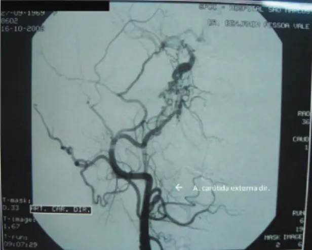 Figura 2. Arteriografia seletiva do sistema carotídeo direito  em sua porção cervical, na incidência lateral: artéria carótida  interna direita não contrastada.