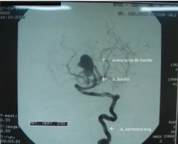 Figura 3. Arteriografia seletiva do sistema vértebro-basilar  esquerdo em sua porção intracraniana, na incidência  ântero-posterior: aneurisma em topo da artéria basilar (imagem de  pré-operatório).