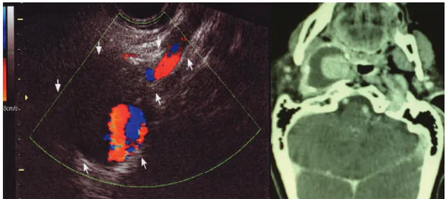 Figura 1. Ultrassonografia da região cervical mostrando grande aneurisma da artéria carótida interna, delimitada com setas