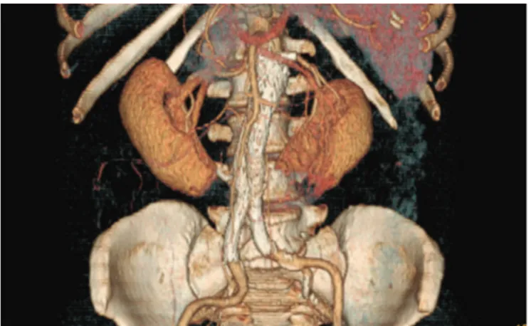 Figura 3. Reconstrução em três dimensões de angiotomografia após reparo endovascular do aneurisma de aorta abdominal, sem 