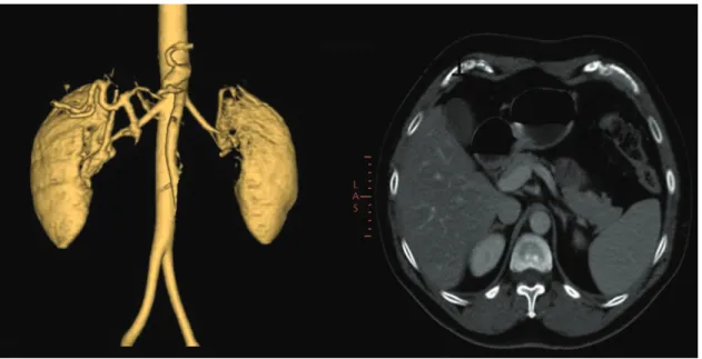 Figura 1. TC de Abdome: reconstrução e corte axial com imagem de dissecção do tronco celíaco com extensão para artéria 